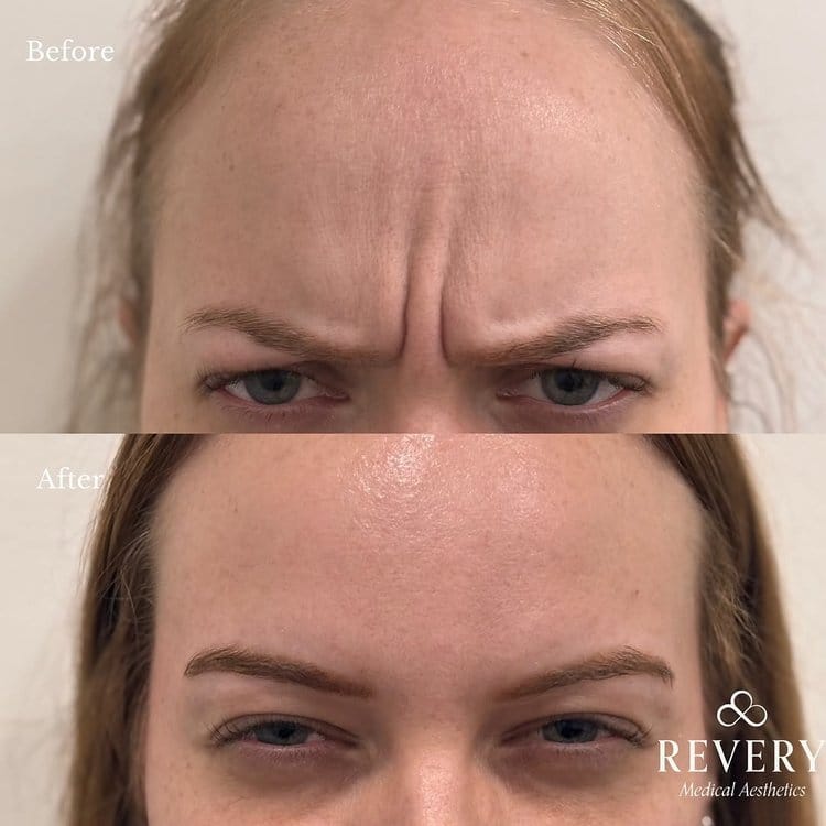 botox before and after windsor lasalle