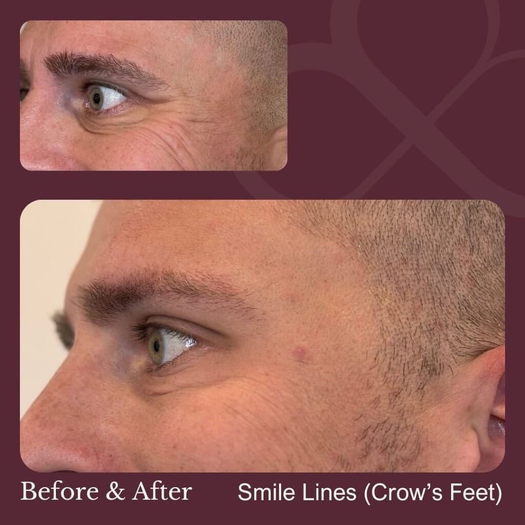 botox treatment windsor