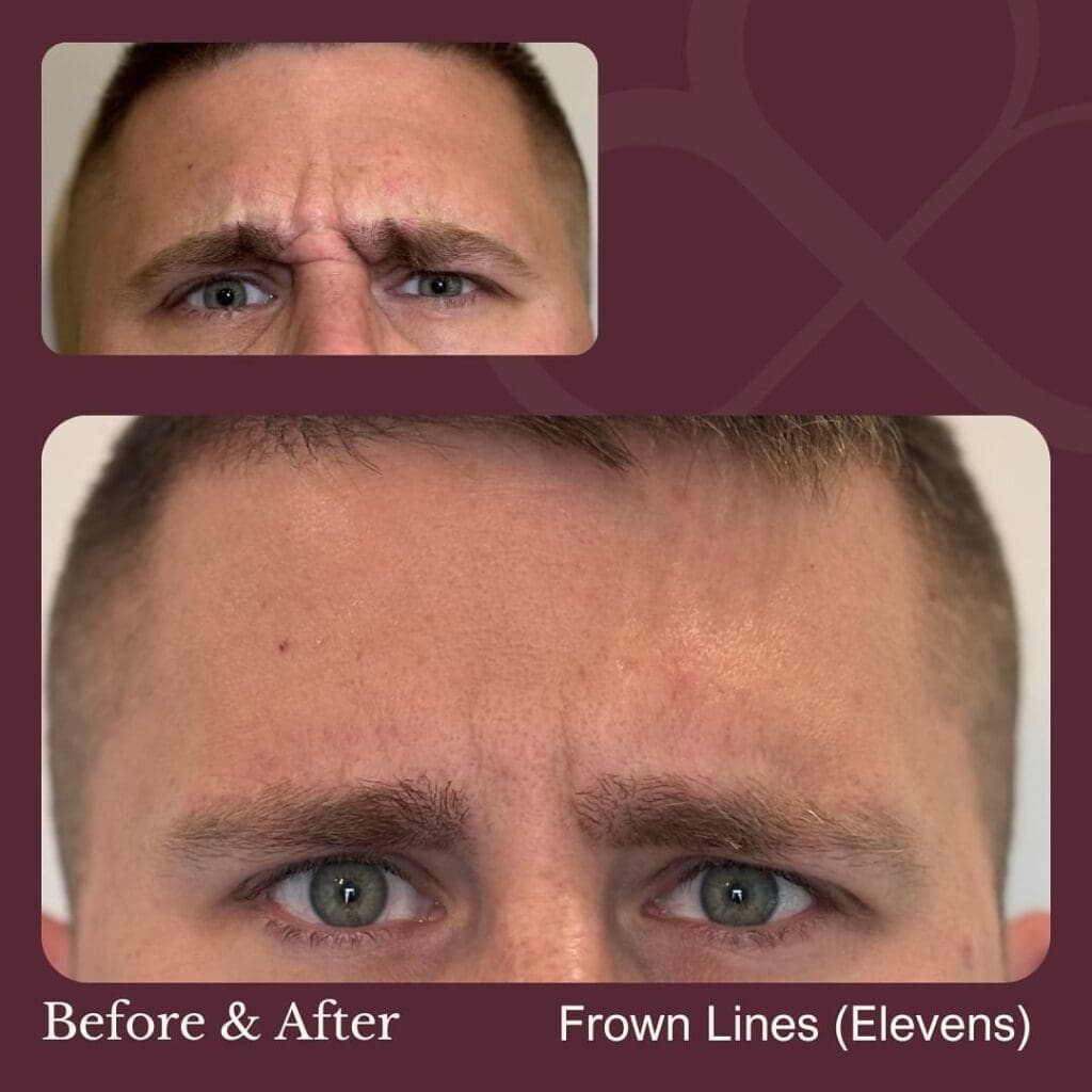 botox treatment windsor