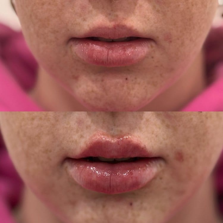 before and after lip injection windsor lasalle medical aesthetics clinic