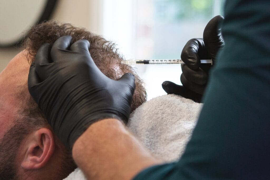 PRP for hair restoration - Revery Medical Aesthetics