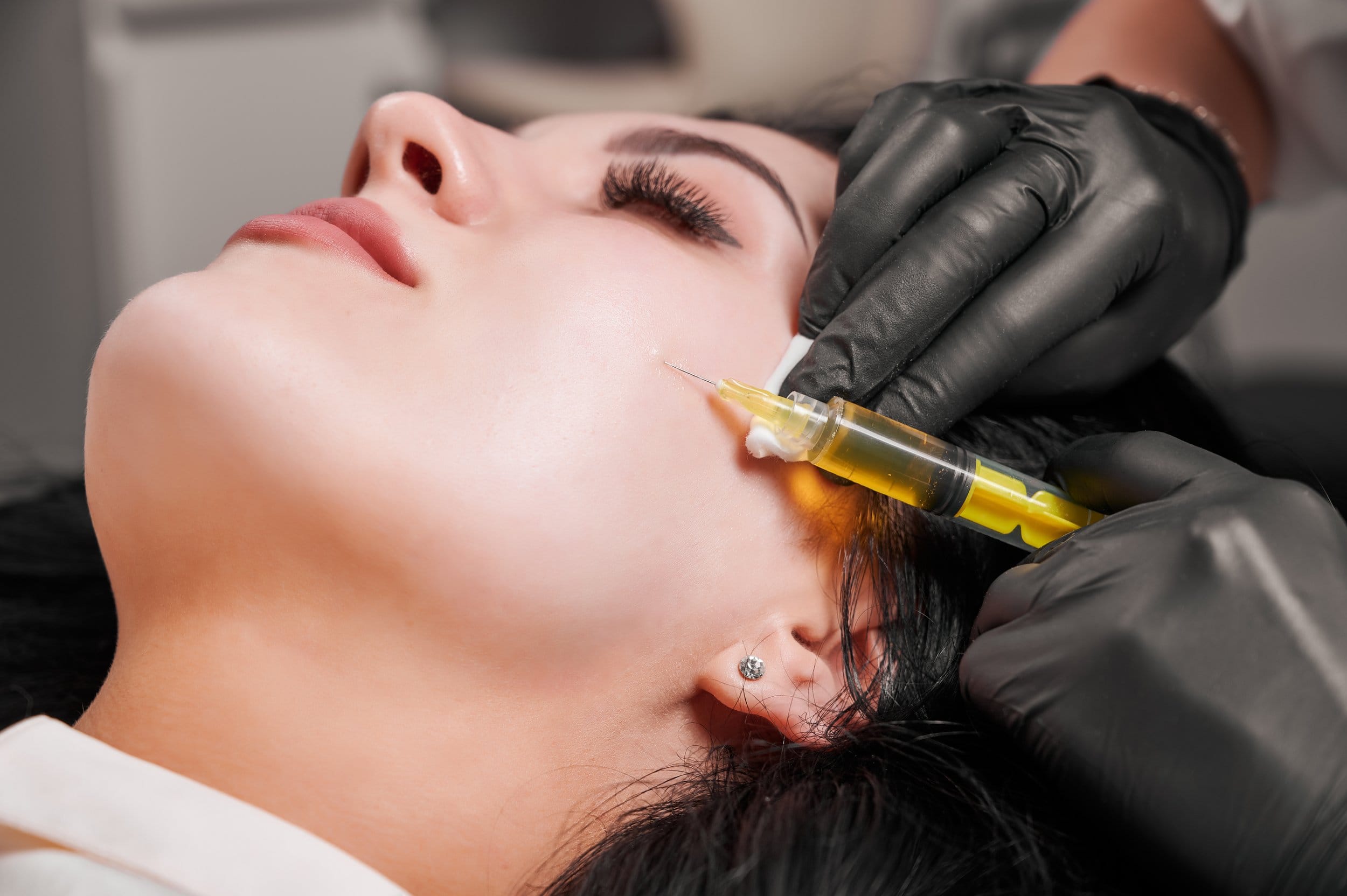 PRP for skin rejuvenation - Revery Medical Aesthetics (LaSalle, near Windsor, ON)