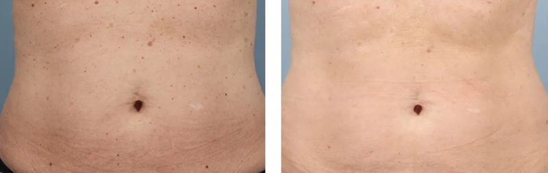 before and after laser skin rejuvenation