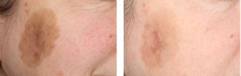 before and after laser skin rejuvenation
