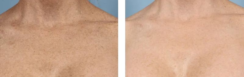 before and after laser skin rejuvenation