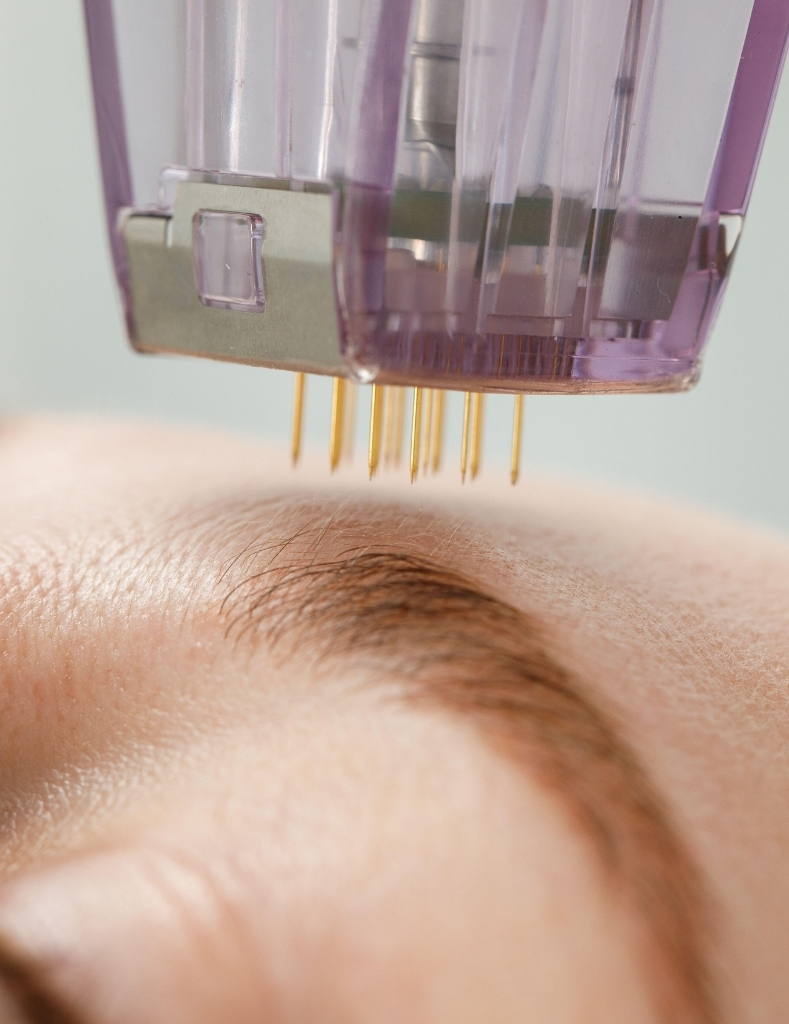microneedling windsor