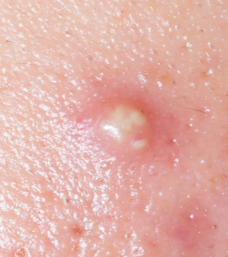 inflamed-acne