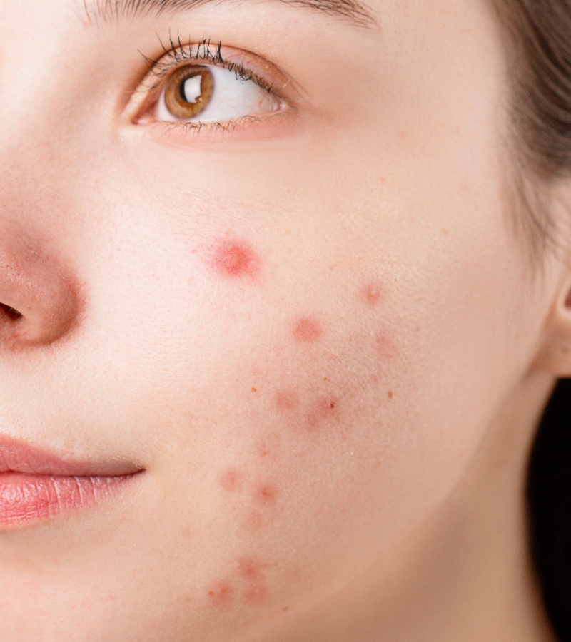 pimples