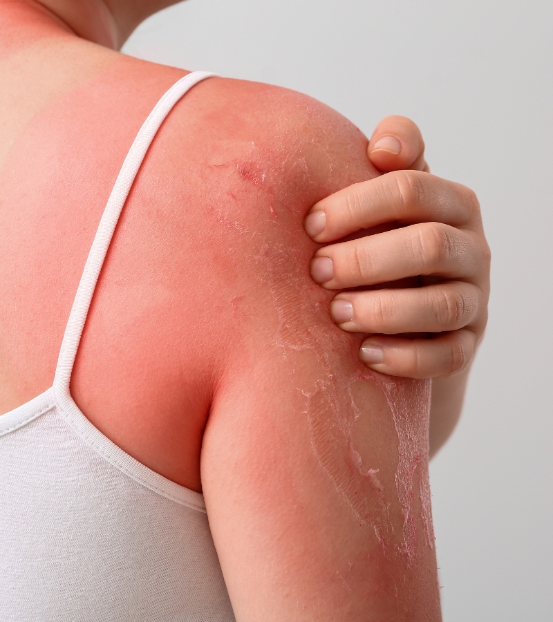 sunburn