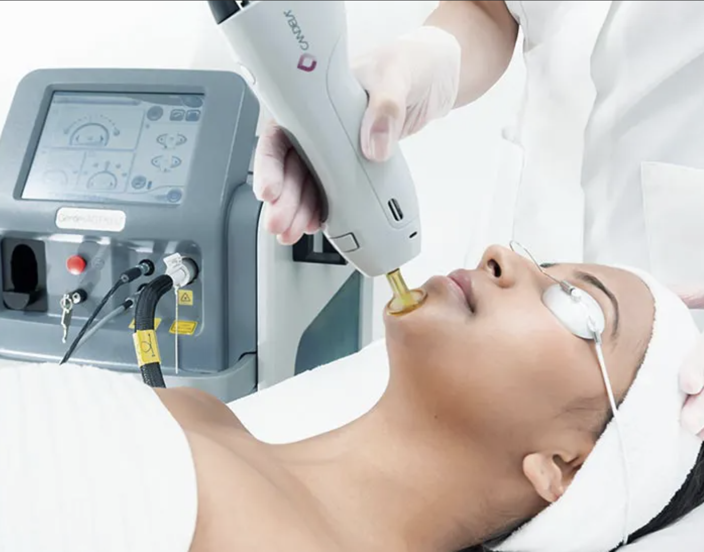 candela laser vein removal windsor