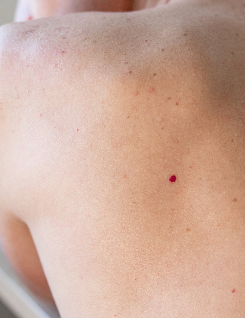 cherry angioma