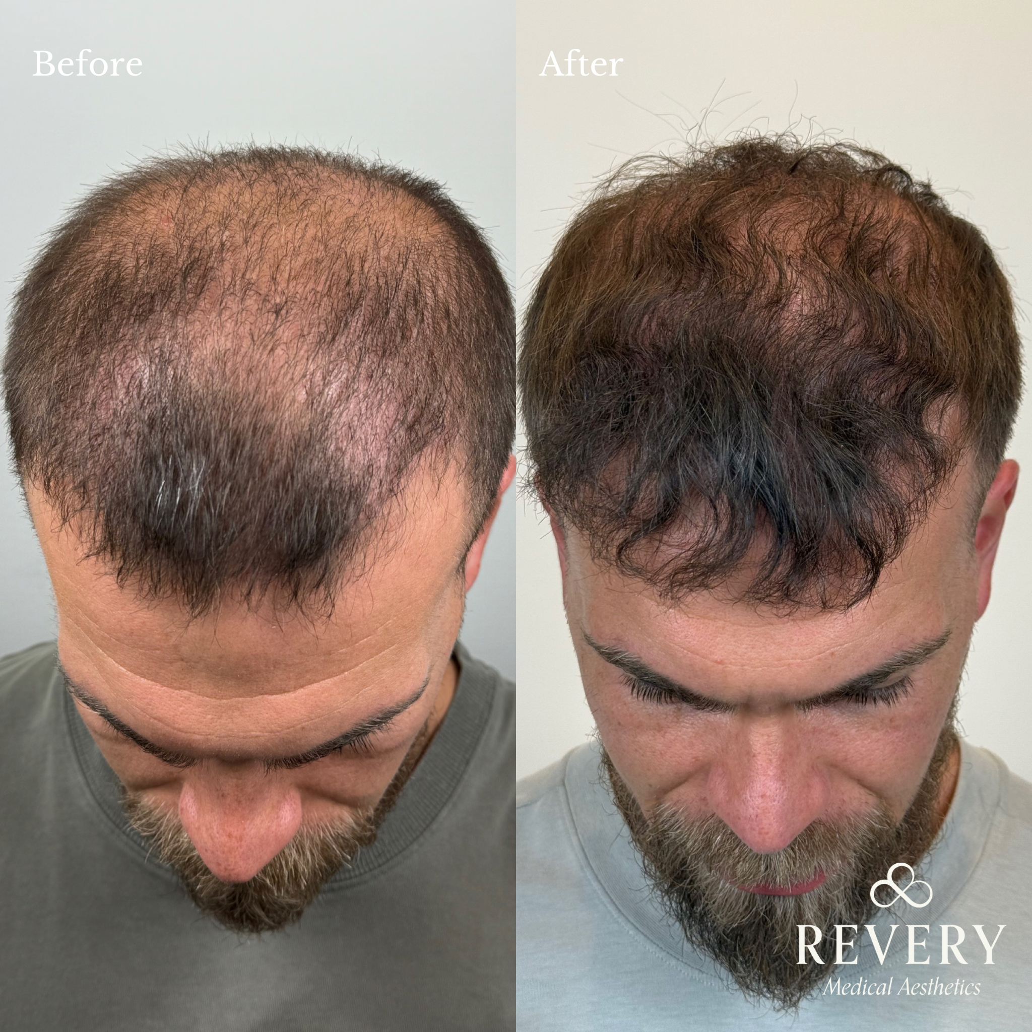 Hair Restoration(1)