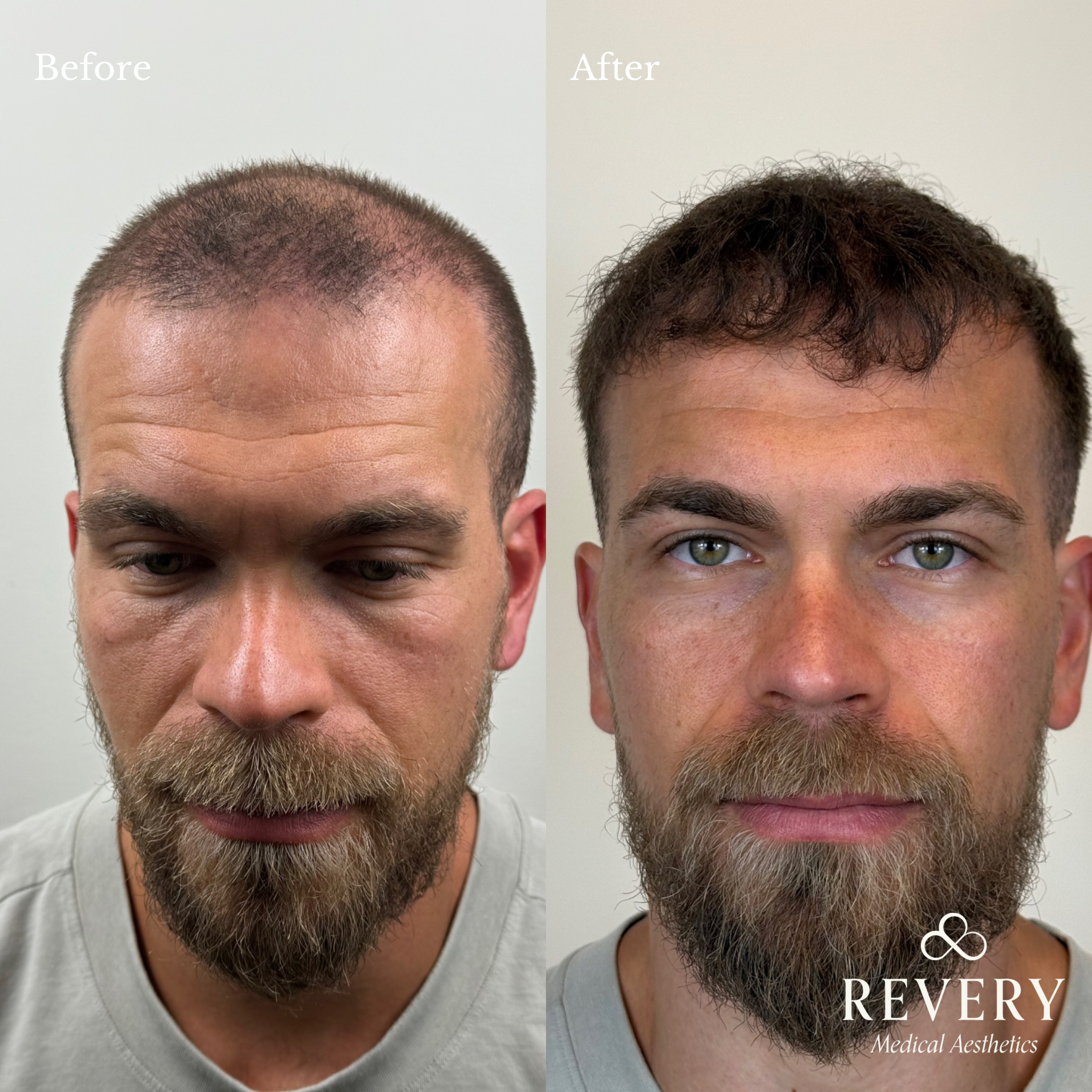 Hair restoration
