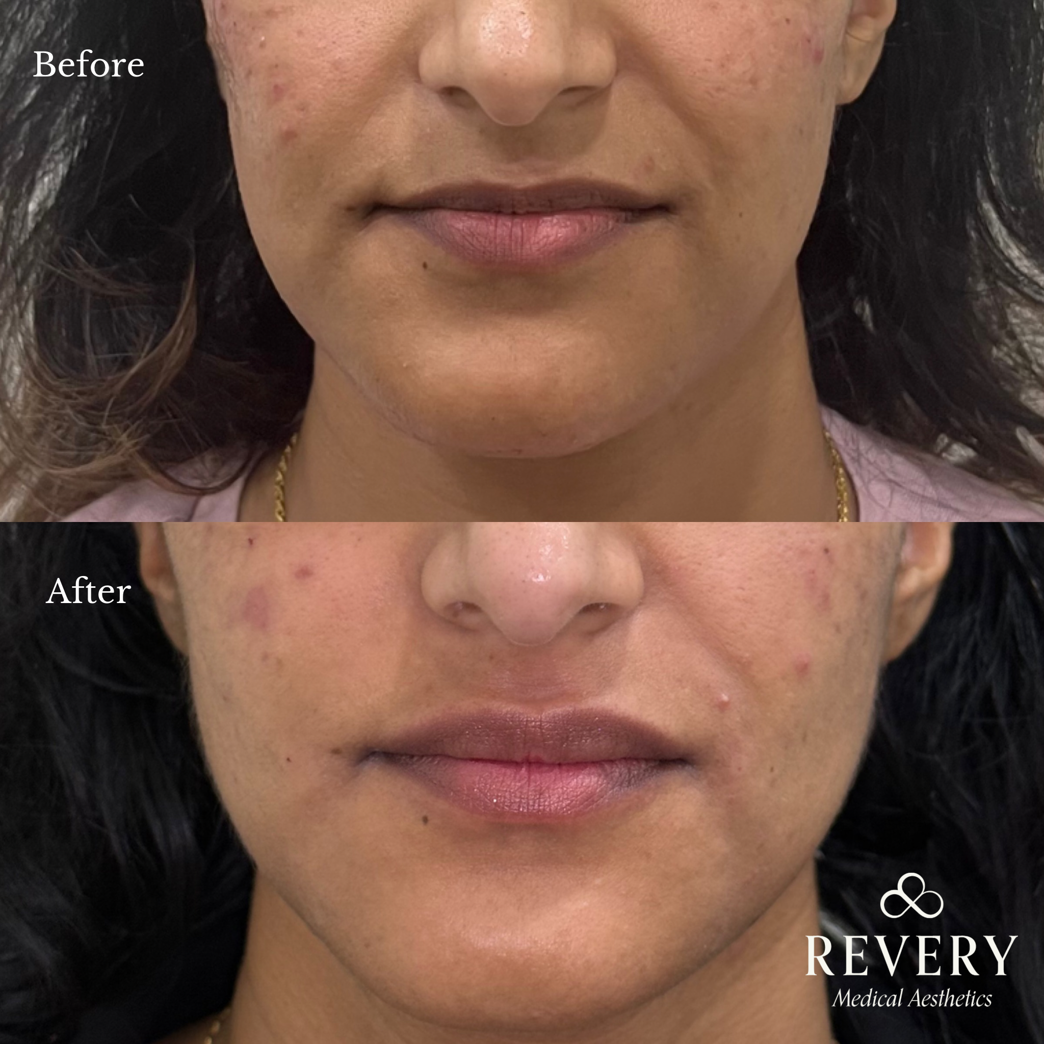 before and after skinbooster windsor