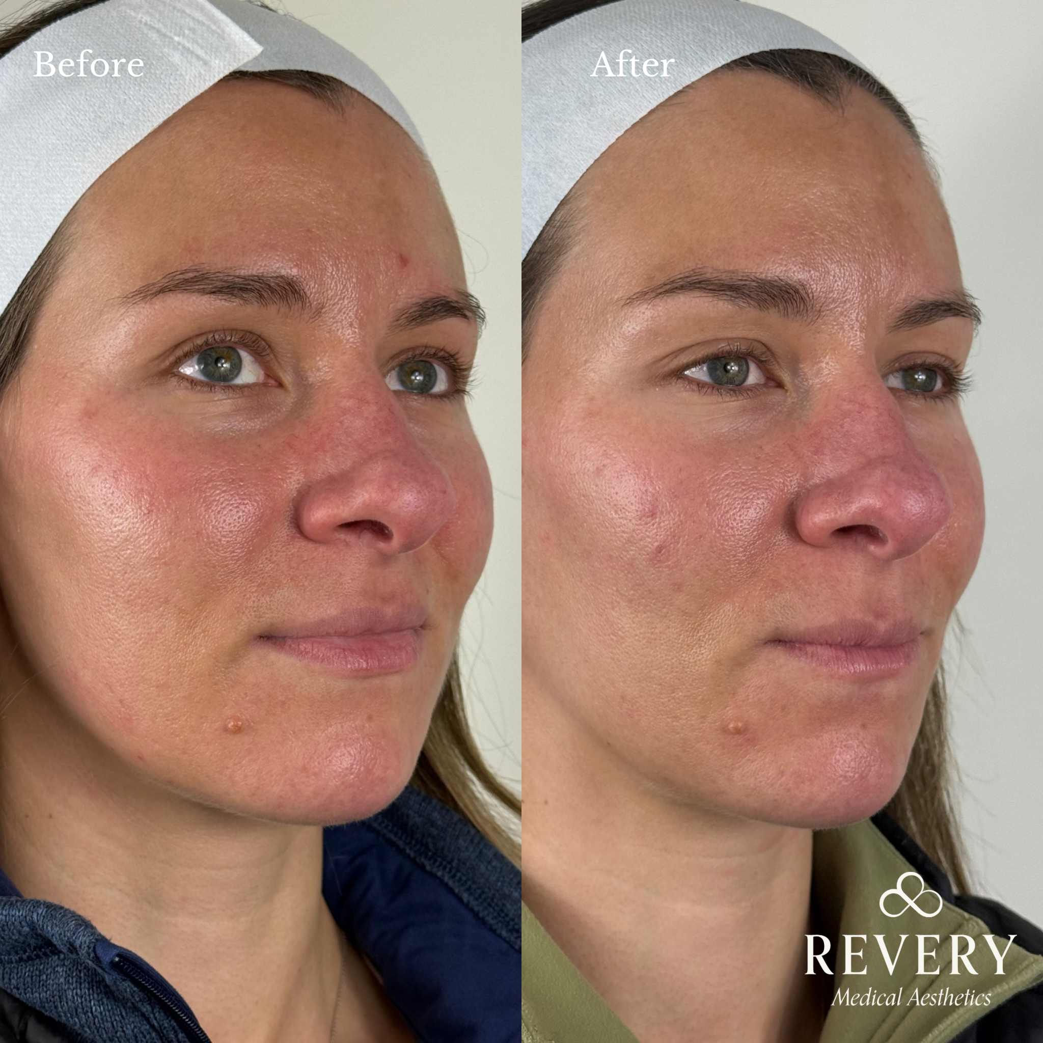 before and after prf treatment windsor