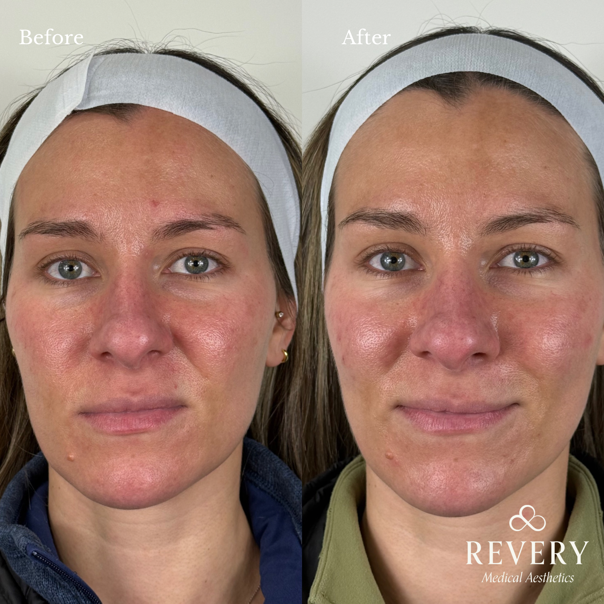 before and after prf treatment windsor