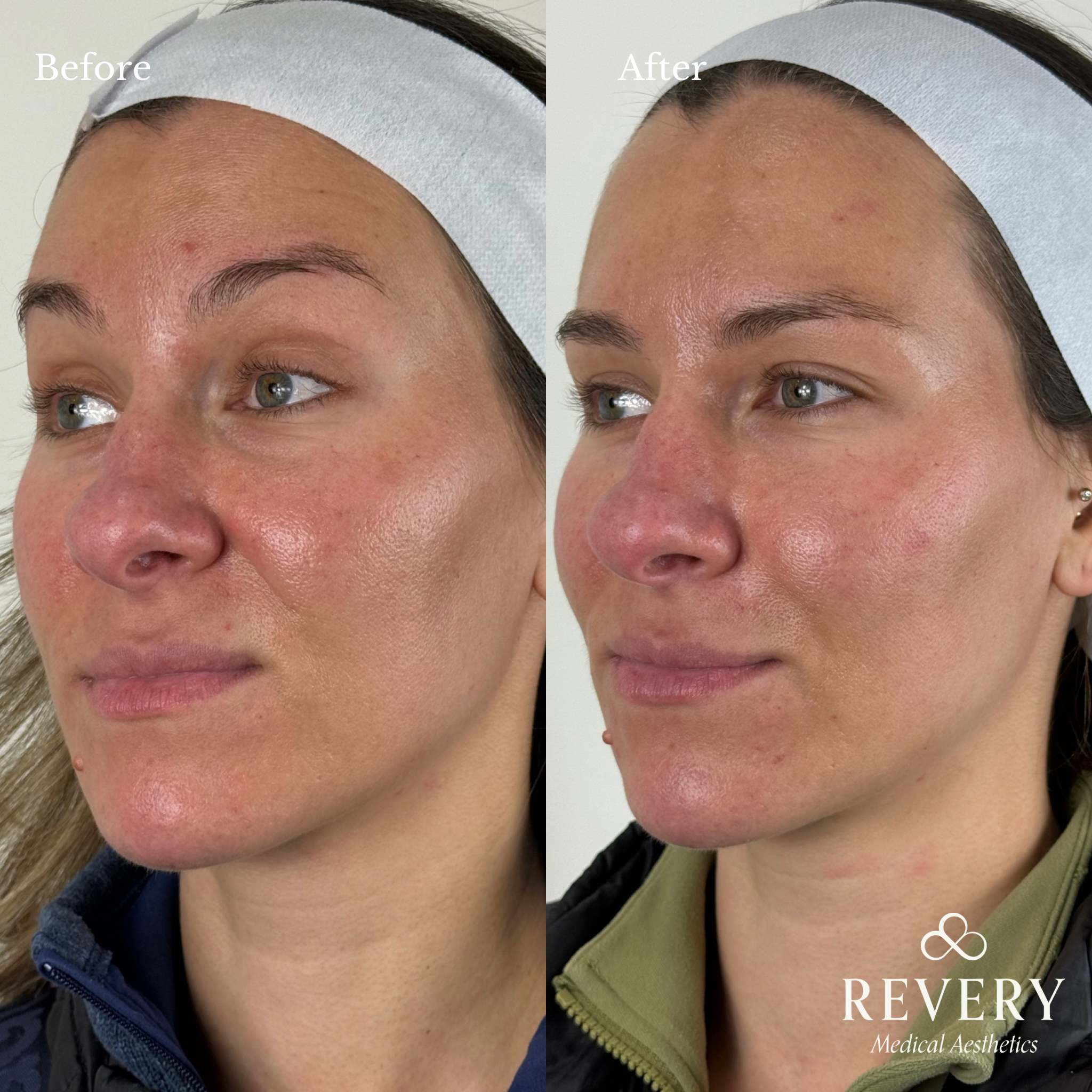 before and after prf treatment windsor