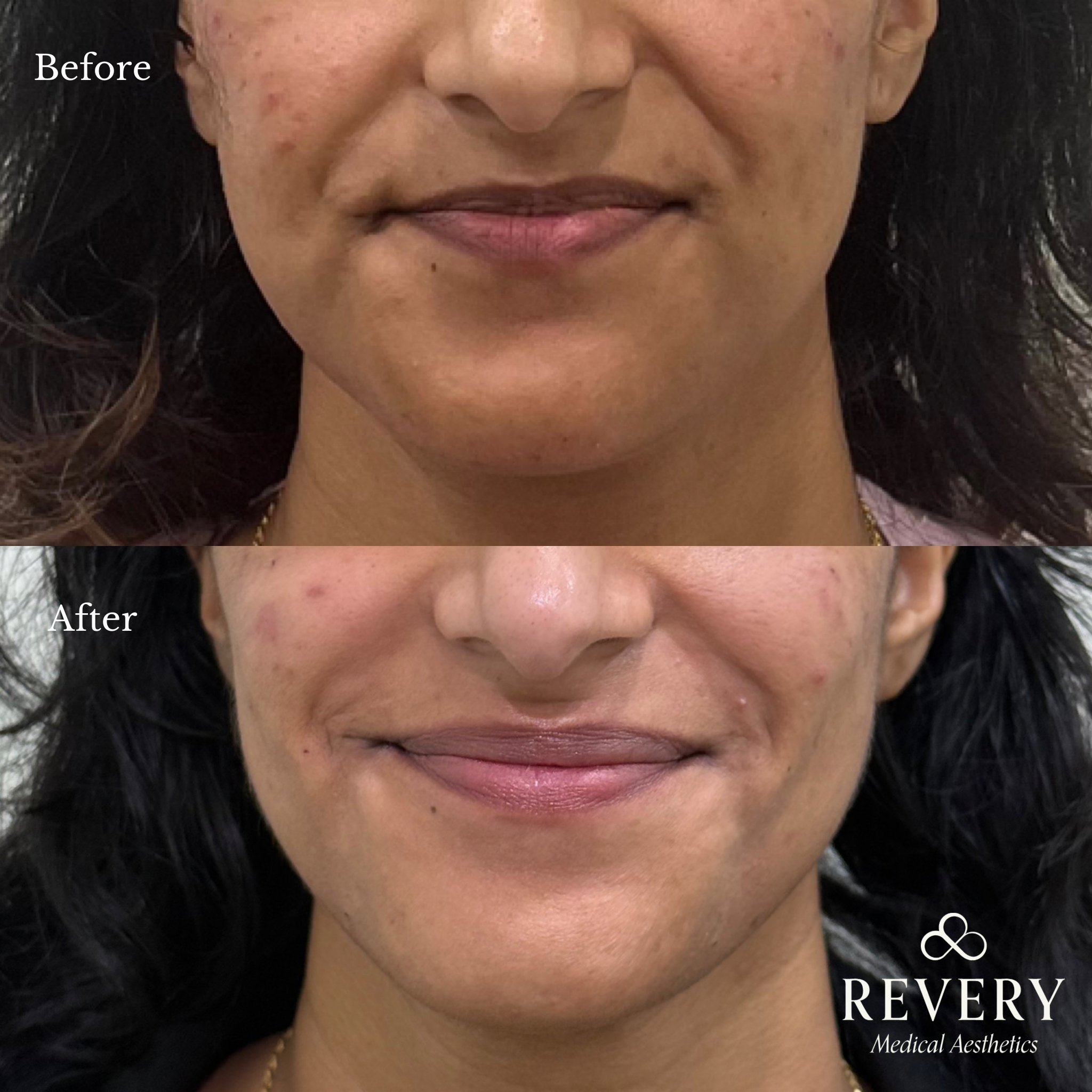 before and after skinbooster windsor