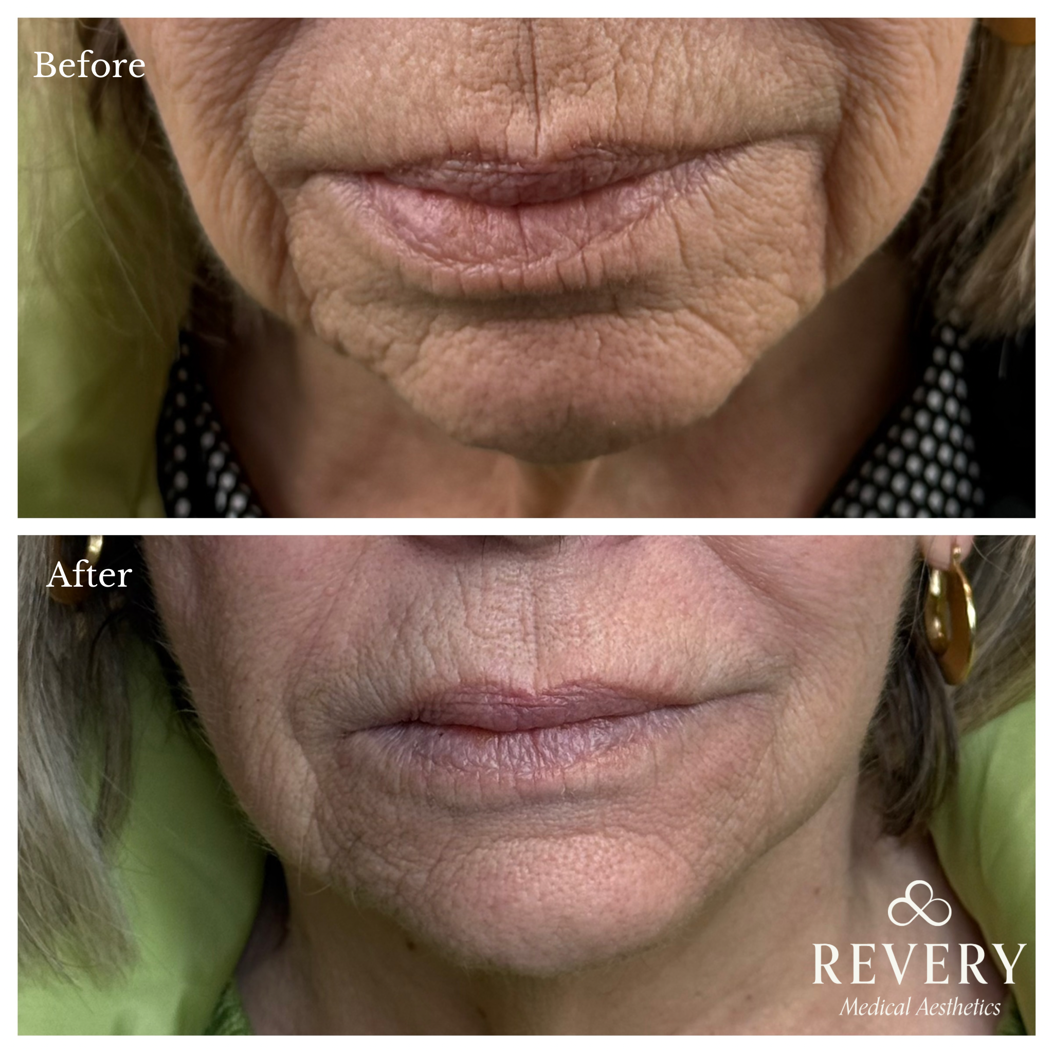 before and after skinbooster windsor