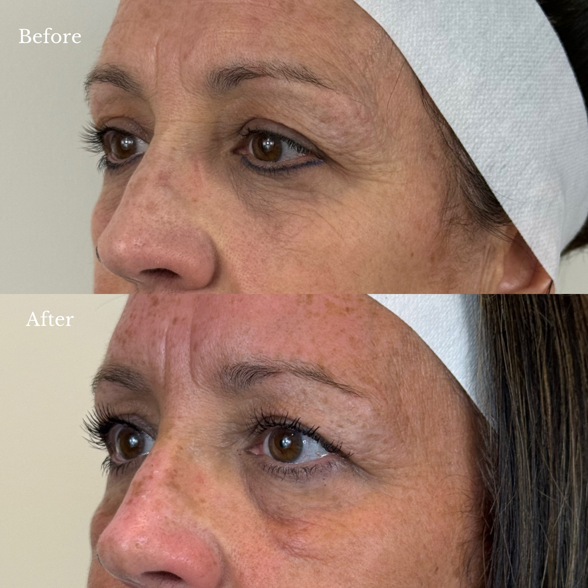 before and after nctf treatment windsor