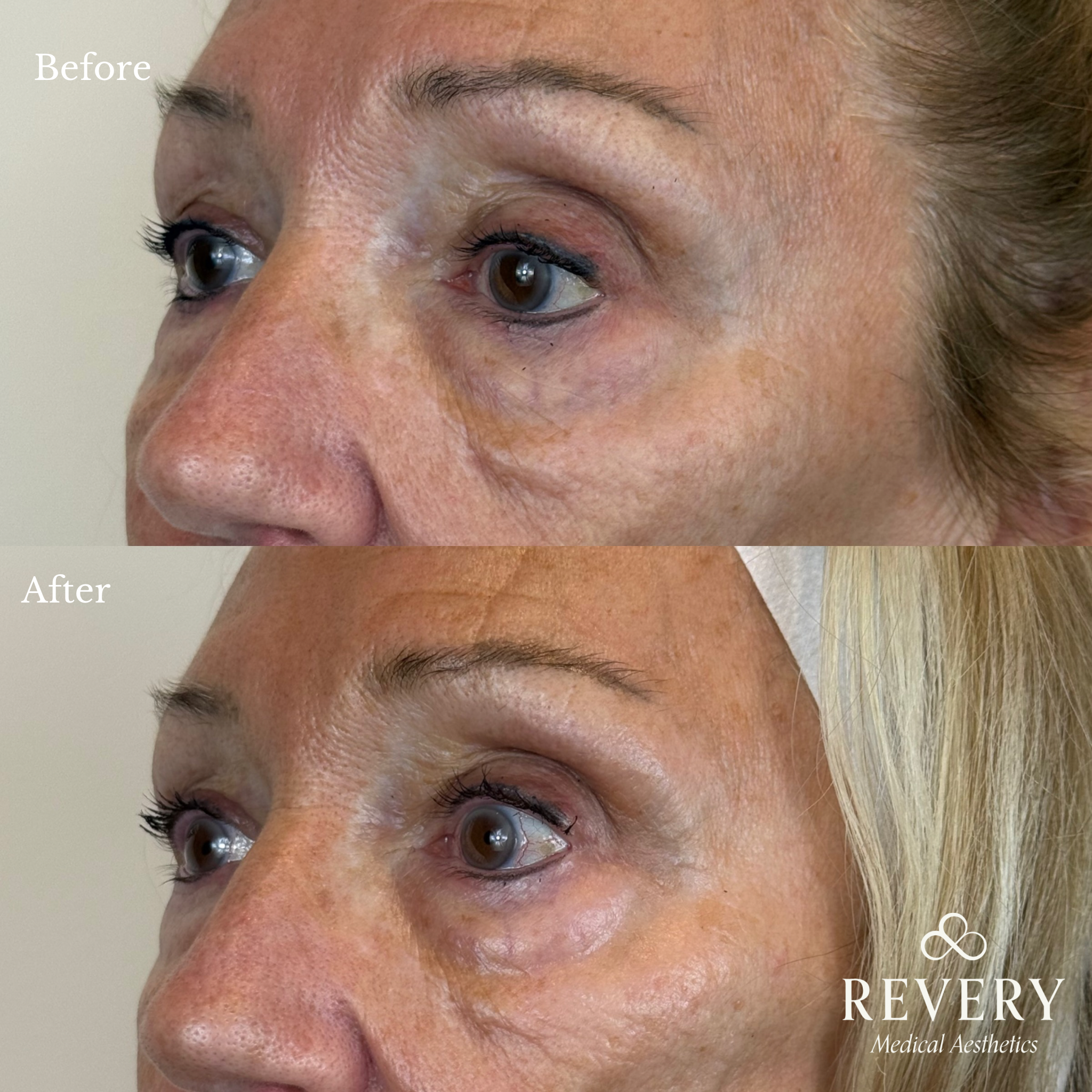 before and after nctf treatment windsor