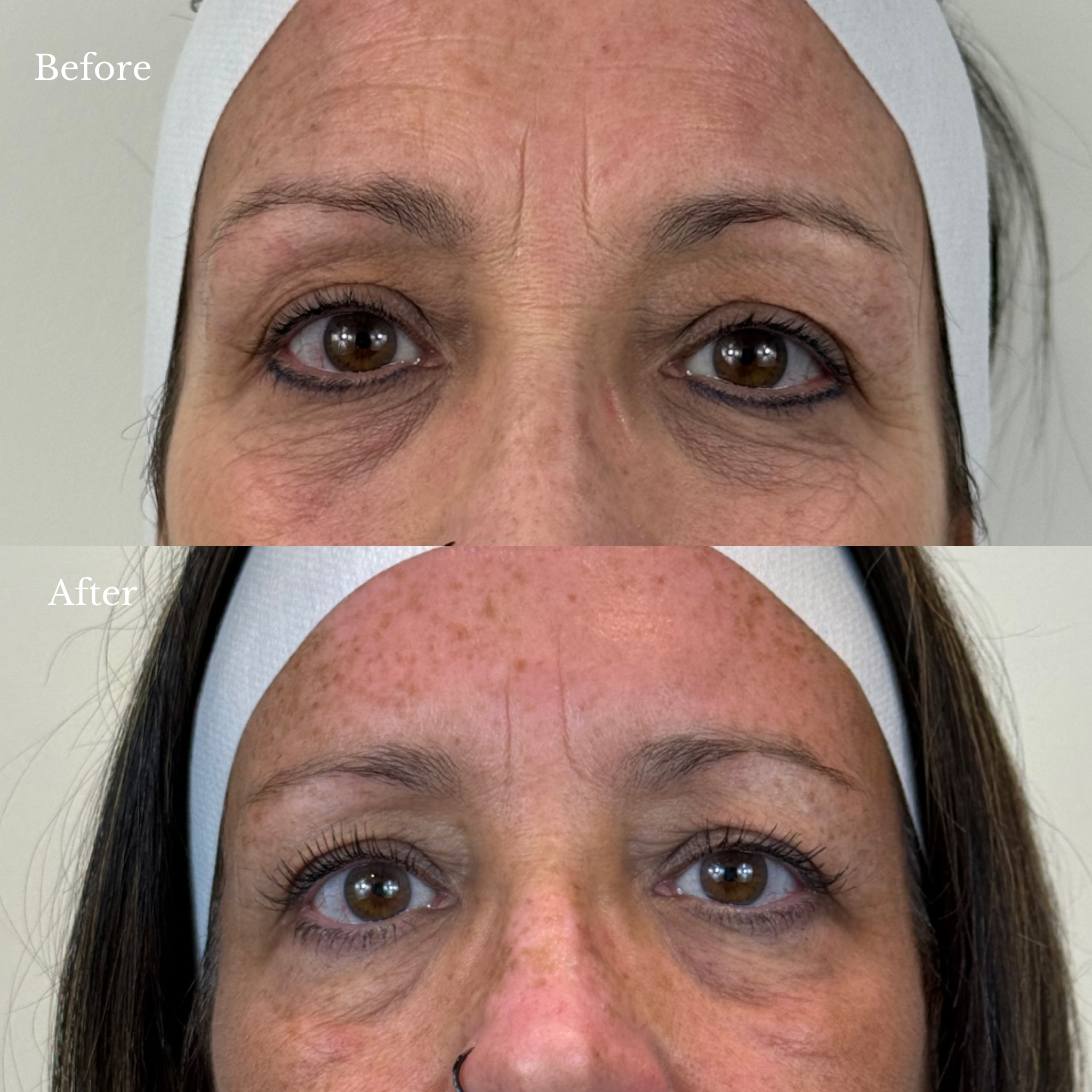 before and after nctf treatment windsor