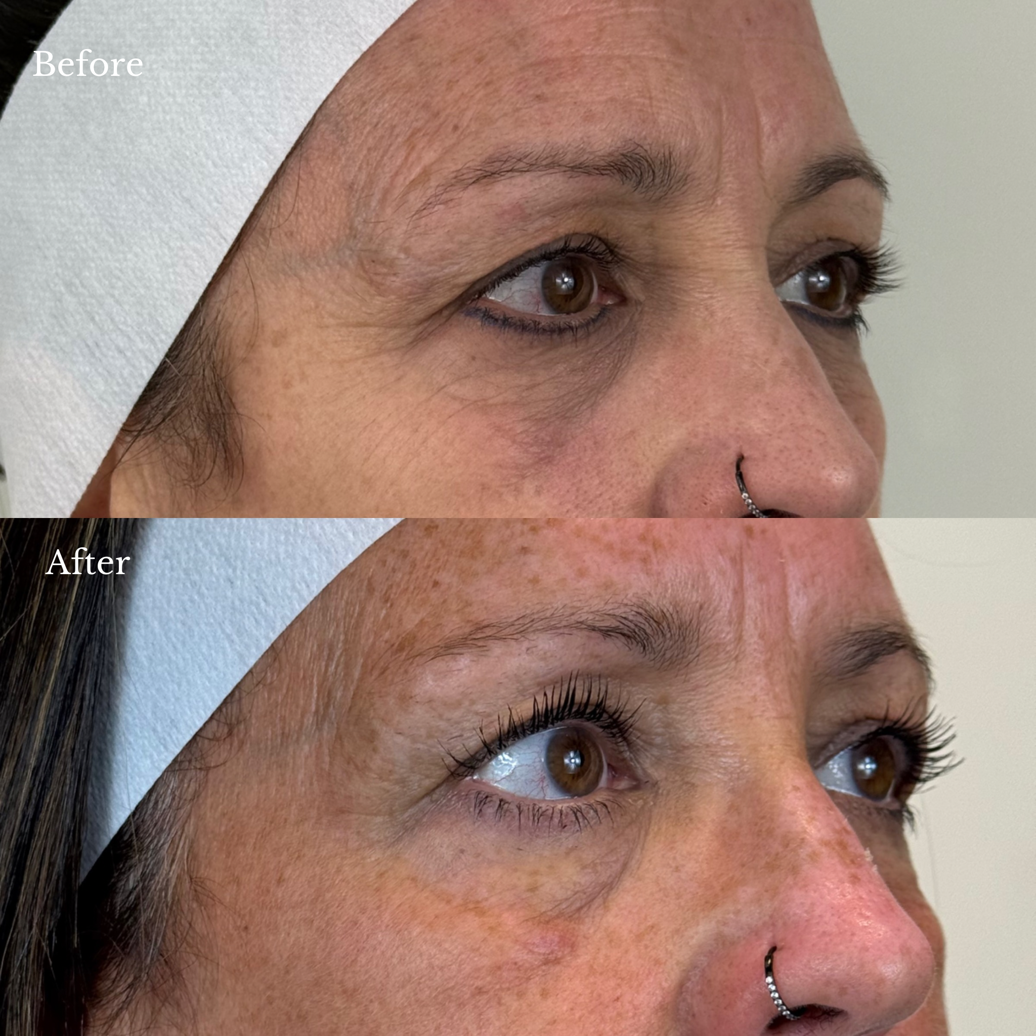 before and after nctf treatment windsor