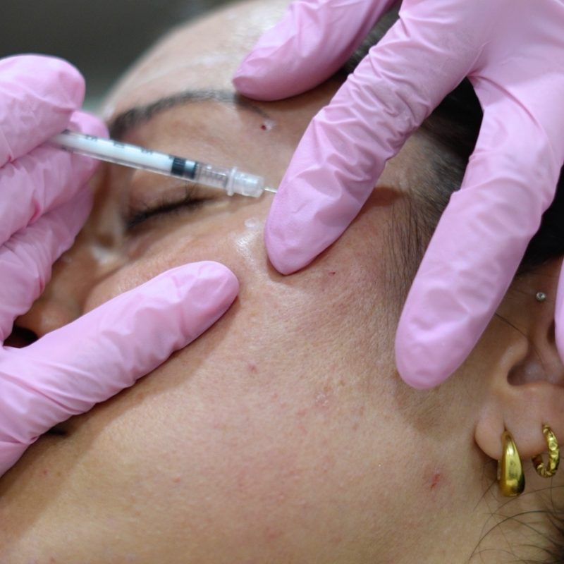 botox-treatment
