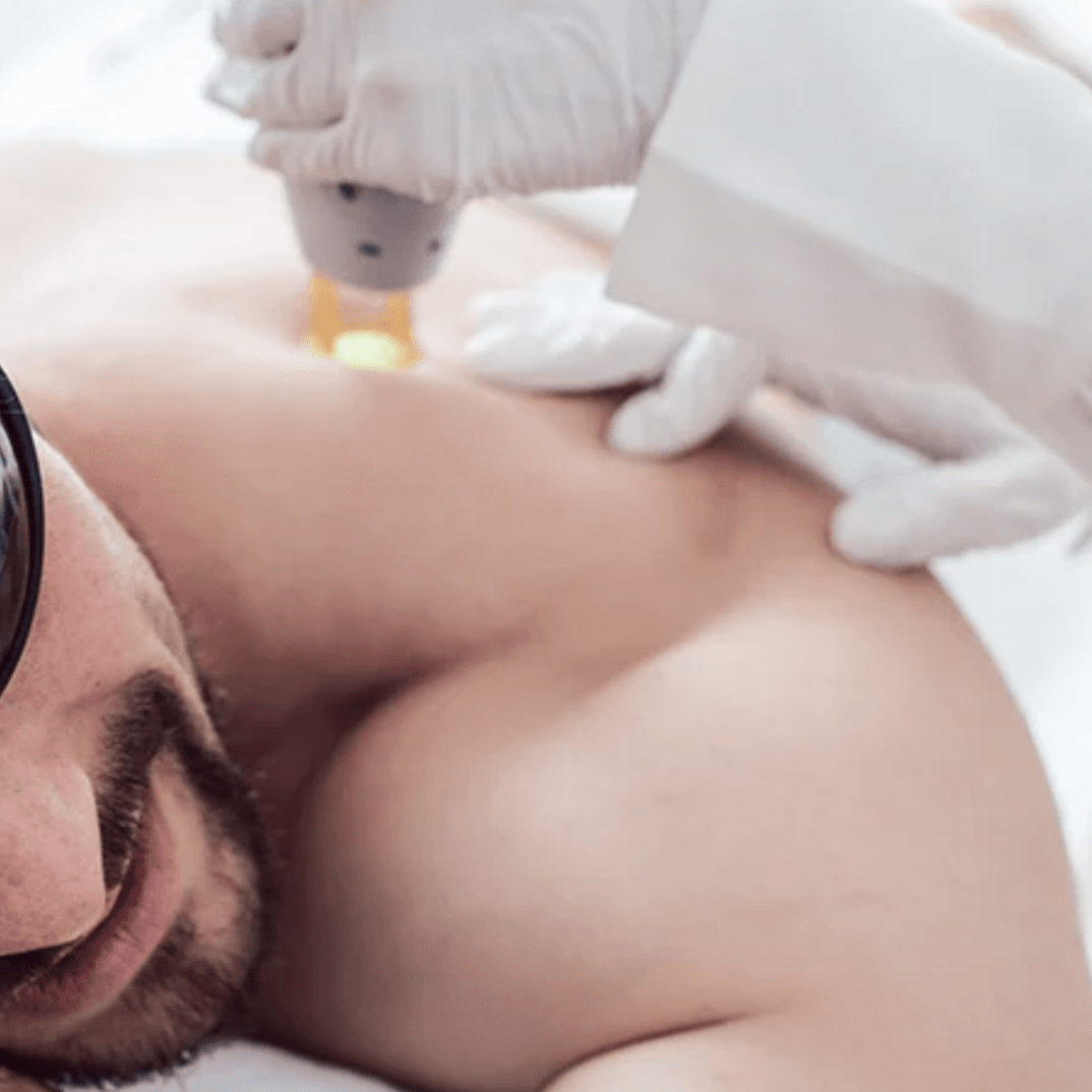 candela laser skin rejuvenation revery medical aesthetics windsor