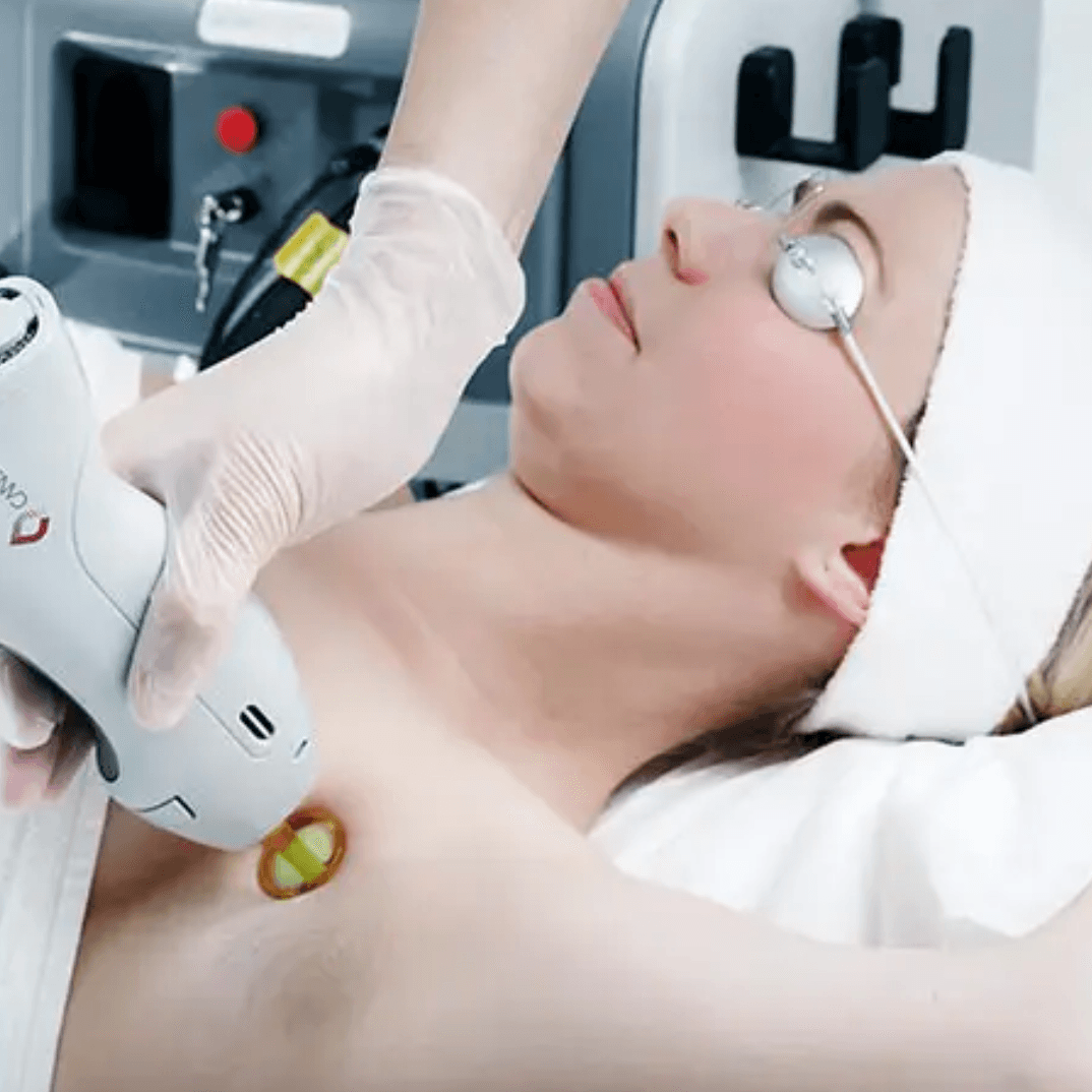 candela laser skin rejuvenation revery medical aesthetics windsor
