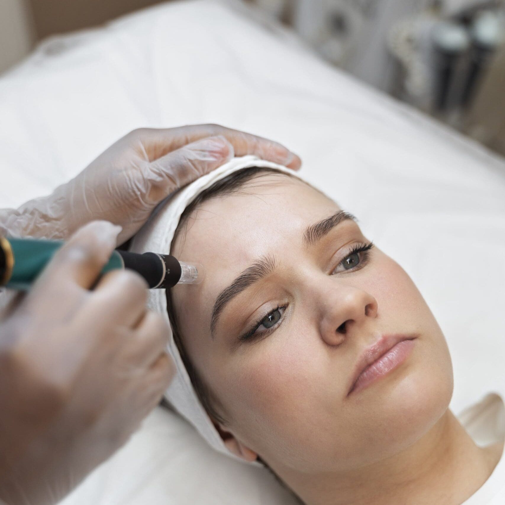 microneedling windsor