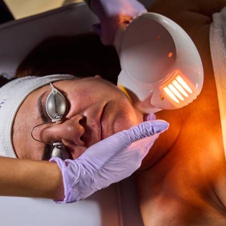 resurface-skin-treatment