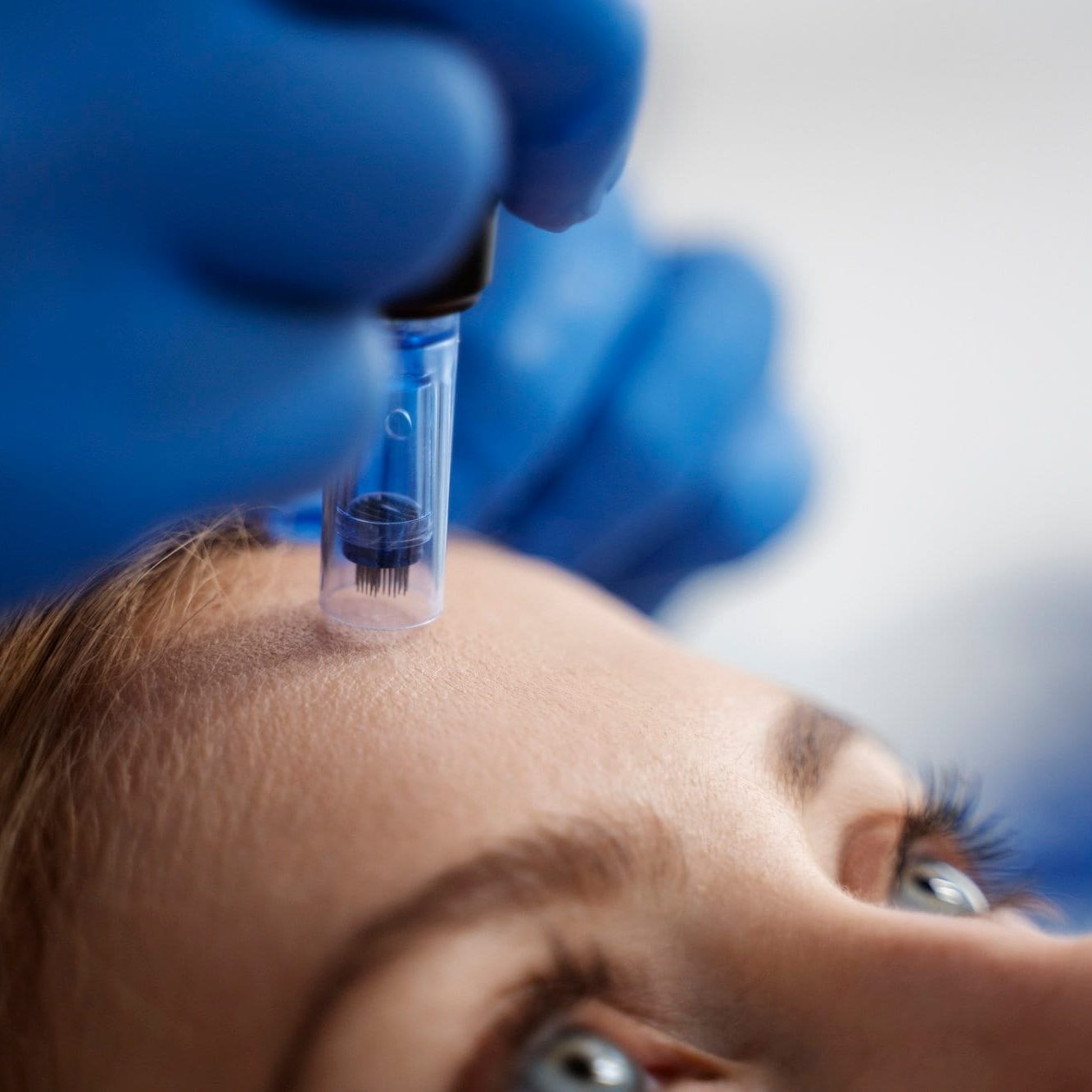 microneedling lasalle revery medical aesthetics
